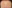 額縮小術（生え際下げ・ヘアライン下降術） — バタン美容外科クリニック
