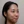 Thread embedding acupuncture lift (Korean-medicine 'maeseon' acupoint thread lift) — after · Garoseo Oriental Clinic - Gangnam Branch