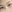 Partial incision double eyelid surgery — Yellow Plastic Surgery Clinic