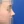 Short nose correction (nose lengthening / derotation) — after (9days) · Yeonse Kyeol Plastic Surgery Clinic