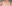 僧帽筋ボトックス（肩ボトックス） — マイン美容外科クリニック