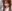 団子鼻修正（鼻尖縮小術） — オブジェ美容外科クリニック