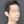 two-jaw surgery (bimaxillary orthognathic surgery) — after (40days) · ReFace Dental Hospital