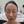Ultracol (PDO microsphere collagen stimulator injection) — before · Project U Clinic