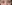 裏ハムラ法（経結膜的眼窩脂肪移動術） — アンド美容外科クリニック