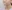 糸リフト（スレッドリフト） — ウィバース美容外科クリニック
