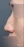 Nasal osteotomy (nasal bone narrowing) — before (7days) · Anersty Plastic Surgery Clinic
