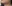 雙下巴抽脂 — 路虎醫美診所