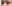 切開法（全切開法二重術） — ハイエンド美容外科クリニック