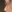 Bulbous nose correction (surgical nasal tip reduction) — Wonderful Plastic Surgery Clinic