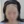 Scalp hair transplant — before (10days) · Vance Mosae Clinic
