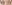 裏ハムラ法（経結膜的眼窩脂肪移動術） — ファクト美容外科クリニック