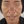 ฉีดไขมันตัวเองทั้งใบหน้า (ศัลยกรรมเติมไขมันใบหน้า) — ก่อนทำ (21วัน) · ซุนพลัสศัลยกรรมพลาสติก