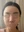 ฉีดไขมันตัวเองทั้งใบหน้า (ศัลยกรรมเติมไขมันใบหน้า) — หลังทำ (14วัน) · คลินิกศัลยกรรมตกแต่ง Jewelry