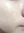 皮下分离术（Subcision，痘坑松解） — 术后 (56天) · Erne诊所