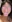 incisional double eyelid surgery — Eight Plastic Surgery Clinic