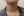 Neck wrinkle Botox (platysma band Botox / Nefertiti lift) — before (22days) · Yeonse Chungarin Clinic