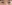 Ptosis Correction (levator surgery / eye-shape correction) — iNique Plastic Surgery & Aesthetics