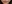 人中短縮（リップリフト） — ハイボム美容外科クリニック