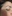 lower blepharoplasty (under-eye bag removal with fat repositioning) — Leaf Plastic Surgery Clinic
