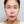 ฉีดฝ้า (ทรานซามิน / กรดทรานเอกซามิก) — หลังทำ (90วัน) · คลินิกเสริมความงาม Oliiting