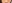 Lower Eyelid Fat Repositioning (transconjunctival) — Pleasure Plastic Surgery Clinic