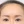 上眼瞼のたるみ取り（上眼瞼リフト・眉下切開） — 術後 (14日) · エイビー美容外科クリニック