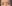 incisional double eyelid surgery — Eight Plastic Surgery Clinic