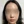 Ultracol (PDO microsphere collagen stimulator injection) — after (2days) · Project U Clinic