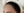 ปลูกผมบริเวณจอน — หลังทำ (180วัน) · คลินิกเสริมความงามเชียงดัมโอเค