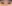 二重まぶた（自然癒着法） — アイフィット美容外科クリニック