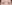 二重まぶた（自然癒着法） — プロミス美容外科クリニック