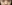 裏ハムラ法（経結膜的眼窩脂肪移動術） — リンク美容外科クリニック