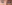 裏ハムラ法（経結膜的眼窩脂肪移動術） — プレジャー美容外科クリニック