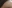 こめかみの脂肪注入 — ユーキャンビー美容外科クリニック