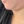ผ่าตัดแก้ไขดูดไขมัน — ก่อนทำ (9วัน) · สกายไลน์คลินิก