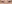 裏ハムラ法（経結膜的眼窩脂肪移動術） — プレジャー美容外科クリニック