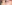 裏ハムラ法（経結膜的眼窩脂肪移動術） — ウィバース美容外科クリニック