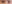 裏ハムラ法（経結膜的眼窩脂肪移動術） — ファクト美容外科クリニック