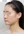 two-jaw surgery (bimaxillary orthognathic surgery) — before (90days) · A-Top Plastic Surgery Clinic