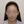 Scalp hair transplant — before (10days) · Okgeon Hairline Clinic