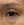 Eyelid filler (upper eyelid hollowing correction) — before (14days) · Wow Plastic Surgery