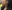 Double chin liposuction (submental liposuction) — Limo Plastic Surgery Clinic