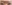 切開法（全切開法二重術） — ウィバース美容外科クリニック