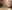 Double chin liposuction (submental liposuction) — Seoul During Clinic