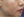 skin booster injection (water glow injection) — before · K-Tox Clinic - Bupyeong Branch