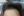 ปลูกผมบริเวณจอน — หลังทำ (140วัน) · คลินิก Richmoa แถวอับกูจอง