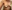 Breast augmentation with implants — Melon Plastic Surgery Clinic