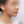 下巴異物取出（下巴假體移除） — 術後 (30天) · Returning醫美診所