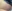 お腹の脂肪吸引（腹部脂肪吸引） — セイエスクリニック